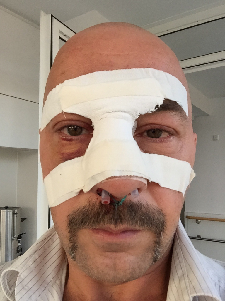 Thomas Barth trägt eine Gesichtsmaske — © So sah Thomas Barth nach seiner Gesichtsoperation aus - jetzt wurde er zum Täter gemacht Foto: Red